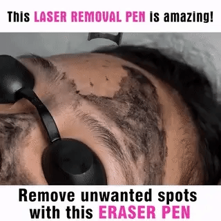 Precision laser pen for freckle, mole, and tattoo removal; a home beauty device.